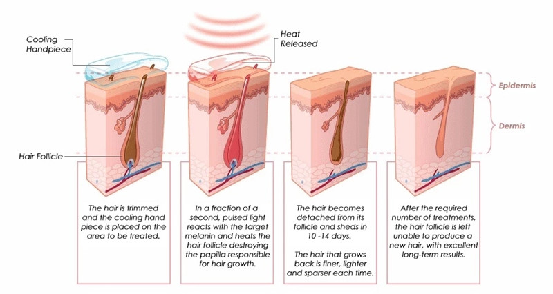 2 en 1 de 808 máquina de diodo láser de eliminación de cabello y Picosecond pulse tatuaje láser máquina de eliminación de 2 en 1 Picosecond pulse máquina láser 808